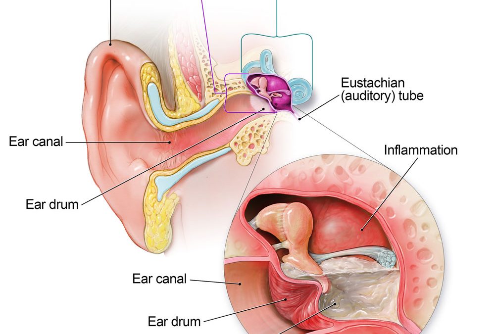 Ear Infections