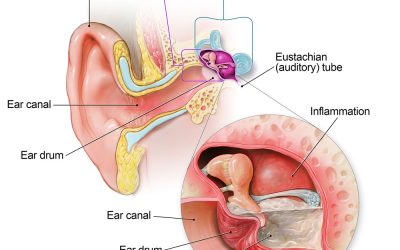 Ear Infections